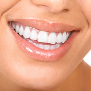 Porcelain Veneers Specialist in Los Angeles