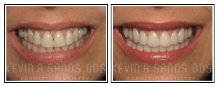 Porcelain Veneers Before and After