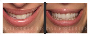 Porcelain Veneers Before and After