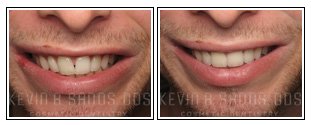 Porcelain Veneers Before and After