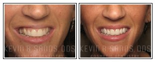 Porcelain Veneers Before and After